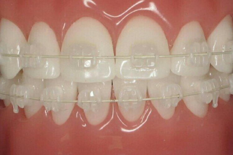 Ceramic Braces Treatment